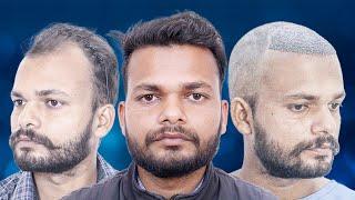 Hair Transplant Result Journey In 5 months || Best Hair Transplant Bhopal | Hair Transplant In India