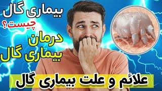 بیماری گال چیست | بیماری گال و روش درمان | درمان بیماری گال | انواع|علائم| علت| عوارض| تشخیص|جلوگیری