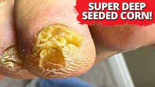 DEEP Corn Removal On Tip Of The Toe!