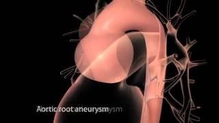 Aortic Disease: Aortic Aneurysm and Dissection