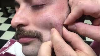 ASMR BEARD CUT • İngrown Beard and treatment • Sleep therapy • Sakal Tras(Kıl Dönmesi)