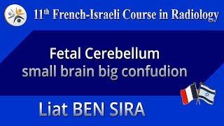 Fetal Cerebellum - small brain big confudion - Liat BEN SIRA