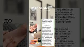 Избавились от бородавок