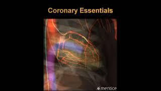 Mentice Coronary Essentials