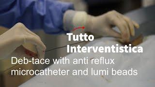 Deb-tace with anti reflux microcatheter and lumi beads