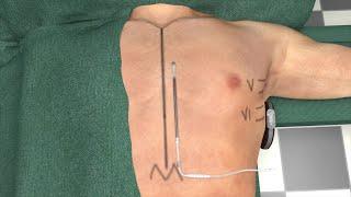 EMBLEM™ S-ICD: Intermuscular 2IT Technique Guide