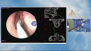 ERS London 2018, Andreas Leunig, Frontal Sinus MasterClass (Cadaveric Dissection)