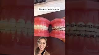 Top Reasons Why Metal Braces Are Better Than Clear Braces