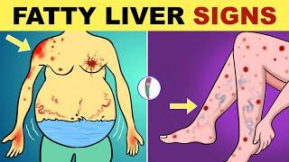 Fatty Liver Symptoms | Early Signs of Fatty Liver Disease | Non Alcoholic Fatty Liver Disease