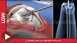 Intramedullary Nailing for Distal Femur Fracture Surgery 3D animation