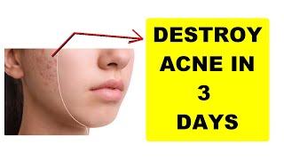 PIMPLE KILLER FORMULA : THAT WILL GET RID OF ACNE IN 3 DAYS !