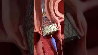 Transcatheter aortic valve implantation procedure (TAVI)