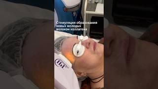 Фотоомоложение ваша волшебная палочка #фотоомоложение