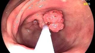 Endoscopic Stomach Polyp Removal