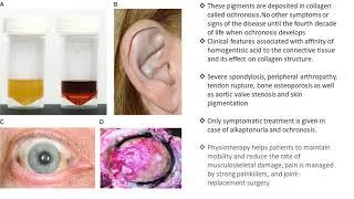 Alkaptonuria