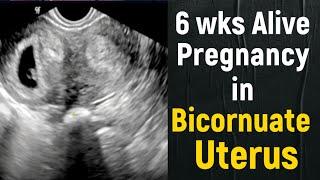 Ultrasound Double Uterus - with 6wks Alive Pregnancy in one.