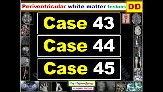Periventricular white matter syndroms; (Radiology Cases 43, 44 & 44)