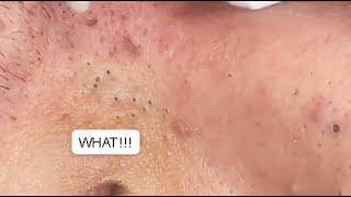 LOTS OF BLACKHEADS ON THE FACE   GREAT JOB GA SPA PART I #relaxing  #blackheads