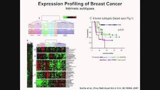 Breast Cancer Diagnosis and Treatment - Stanley Lipkowitz