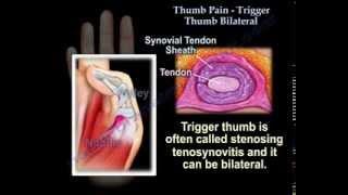 Thumb Pain , Trigger Thumb , Bilateral - Everything You Need To Know - Dr. Nabil Ebraheim