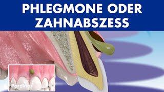 PHLEGMONE - Symptome und Behandlung von ABSZESS Zahnfleisch ©