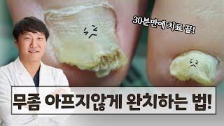 무좀! 통증 없는 완벽 치료방법 | 임신 및 수유부 어린이도 가능한 치료라고?  |무좀제거영상