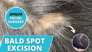 GETTING RID OF A BALD SPOT ON FEMALE (EXCISION OF BALD SPOT) - DR. TANVEER JANJUA - NEW JERSEY