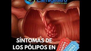 Síntomas de Pólipos en el Colon