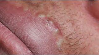 LOTS OF BLACKHEADS AROUND THE LIPS   GREAT JOB SOPHIA #relaxing  #blackheads