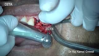 Single Drill protocol (Simpladent Implants)