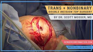 Double Incision Top Surgery Performed by Dr. Scott Mosser, MD