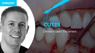 Dental Implant Placement