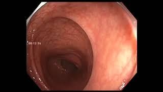 Colonoscopy: