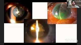 THE INTRICACIES OF MACULAR HOLE SURGERIES Dr  Sripathi Kamath & Dr  Jatinder Singh Debate