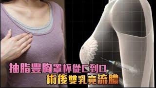 【春節變身】抽脂豐胸罩杯從C到D　術後雙乳竟流膿 | 台灣蘋果日報