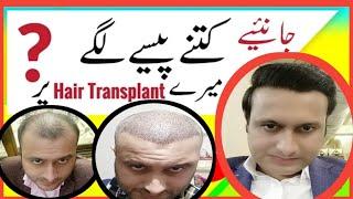 Hair Transplant Price | Hair Transplant cost | Hair Transplant in Pakistan | Hair Transplant Results