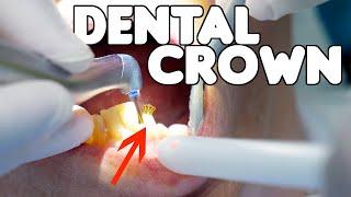 Dental Crown Procedure EXPLAINED