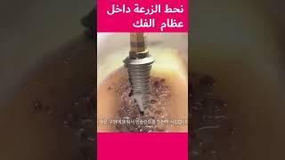 زراعة الاسنان الفورية في 20 ثانية | tooth implant process #shorts