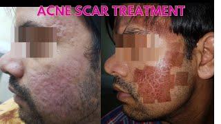 Laser acne scar removal || Before and after results || Laser treatment for scars