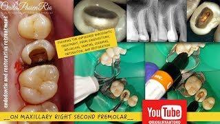 squirting obturation endodontic, active ultrasonic irrigation spesialis konservasi gigi endodontist