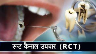 रूट कैनाल उपचार (क्राउन के साथ) | RCT (Root Canal Treatment) with Crown | Curveia Dental Animation