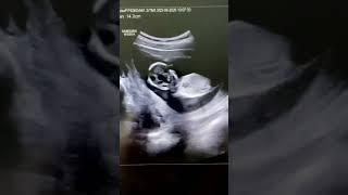 Ҳомилада гематома #doctorYakubjonov #андролог #baby #pregnant #бепуштлик #уролог #гинеколог #doctor