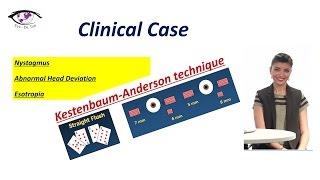 Case Report: The Effectiveness of Kestenbaum-Anderson Procedure / Eye - Dr.Tuti