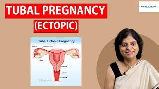 Tubal pregnancy: symptoms, diagnosis, treatment| एक्टोपिक प्रेगनेंसी क्या है लक्षण| Dr Neera Bhan