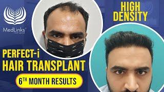 Perfect-i Hair Transplant Results | MedLinks Hair Transplant Results | Dr. Gaurang Krishna