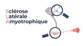 La sclérose latérale amyotrophique