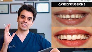 Case Discussion 8 - Composite Veneers