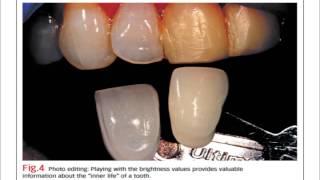 Bench Mastery: IPS e.max for veneers