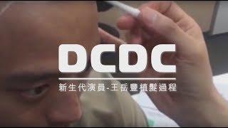 DCDC精準植髮》新生代演員─王岳豐植髮全紀錄-朱冠州醫師主治