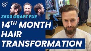 Hair Transplant Turkey 3600 Grafts - 14 Months Transformation FUE Before/After